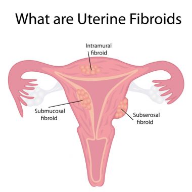 Types of Uterine Fibroids clipart