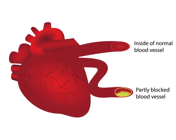 Corazón con vaso sanguíneo normal y parcialmente bloqueado — Vector de stock