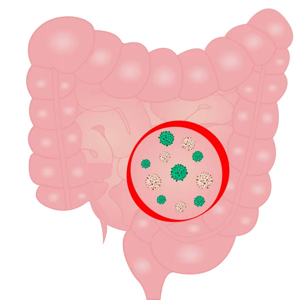 Detener la infección por el virus en el intestino delgado — Vector de stock