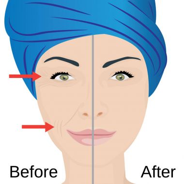 Aging yüz tedavi. Önce ve sonra