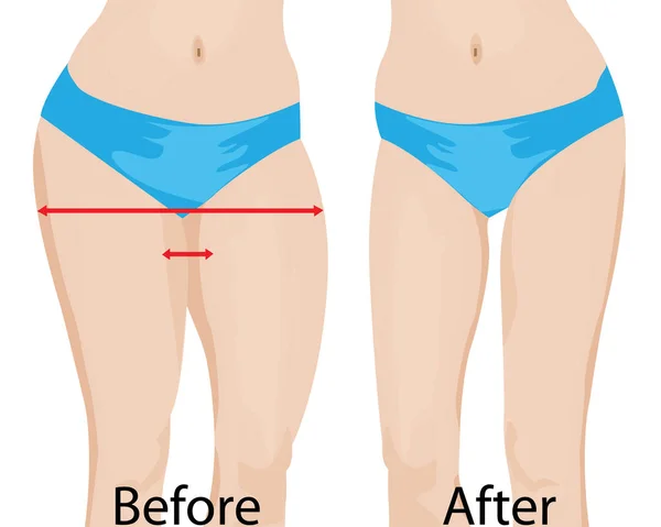 Caderas gordas y delgadas para niñas. Antes y después . — Vector de stock