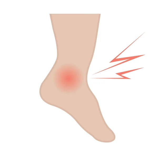 Hinchazón de los pies y tobillos por infección o lesión — Vector de stock