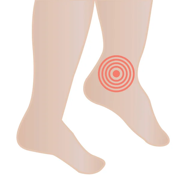 Inchaço dos pés e tornozelos por infecção ou lesão — Vetor de Stock