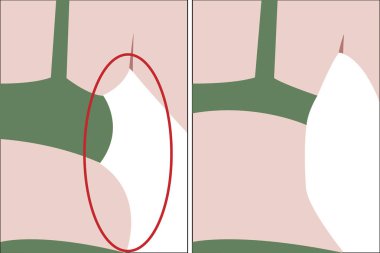 Şişko ve kızın geri ince. Önce ve sonra