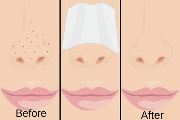 Černé tečky na Nose a léčba — Stockový vektor