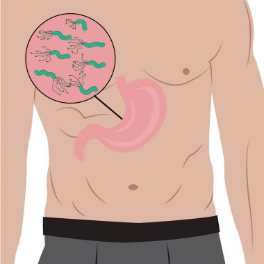 A Stomach full of Helicobacter pylori in the people's body. gastritis cause. Vector illustration in cartoon style clipart
