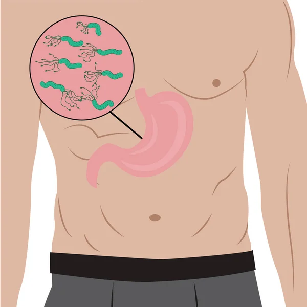 Желудок, полный Helicobacter pylori в организме людей. Причина гастрита. Векторная иллюстрация в стиле мультфильма — стоковый вектор