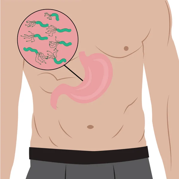 Um estômago cheio de Helicobacter pylori no corpo das pessoas. causa de gastrite. Ilustração vetorial em estilo cartoon — Vetor de Stock