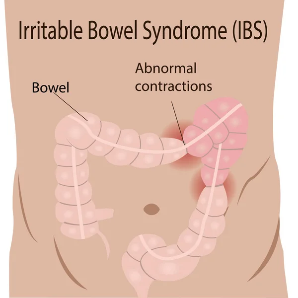 Sindrome dell'intestino irritabile (IBS) in un intestino crasso — Vettoriale Stock
