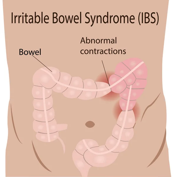 Prikkelbare darmsyndroom (Ibs) in een dikke darm — Stockvector