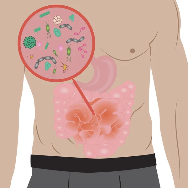 Stop infectie begroeiing in de darm vectorillustratie — Stockvector