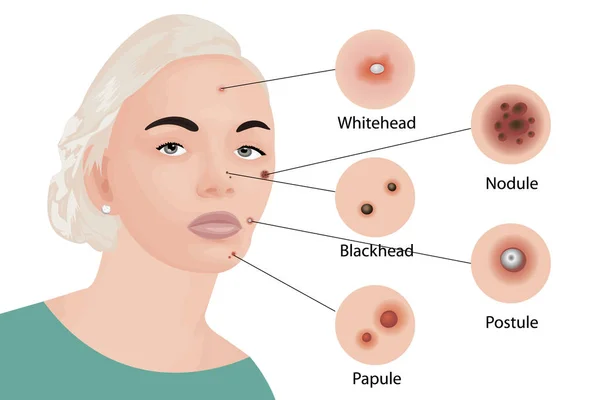 Tipi di acne illustrazione vettoriale. Cosmetologia — Vettoriale Stock