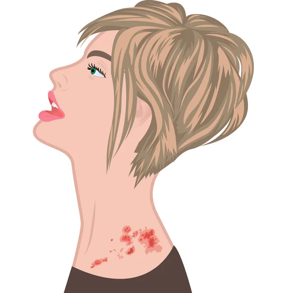 Herpes zóster en el hombro de una mujer. ilustración vectorial varicela zoster — Vector de stock