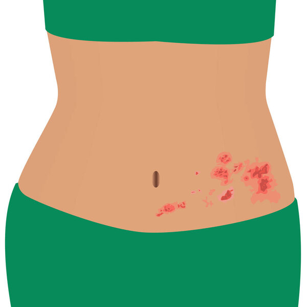 Shingles on a woman body   varicella zoster   vector illustration