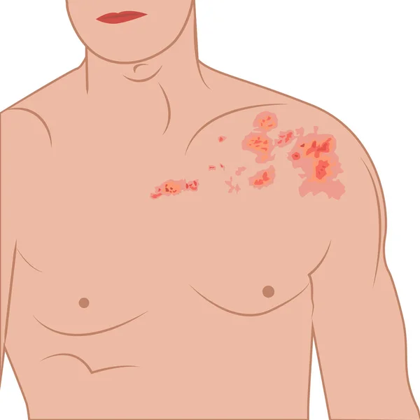 Herpes zoster su un uomo corpo vettoriale illustrazione — Vettoriale Stock