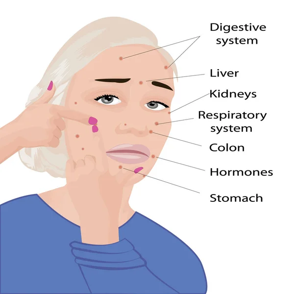 Mapeamento facial. O que sua acne dizendo-lhe info-gráfico —  Vetores de Stock