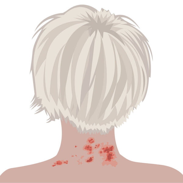 Shingles on a woman neck vector illustration