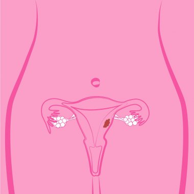 Uterin Fibroid vektör çizim