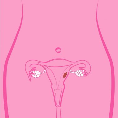 Uterine Fibroid vector illustration clipart