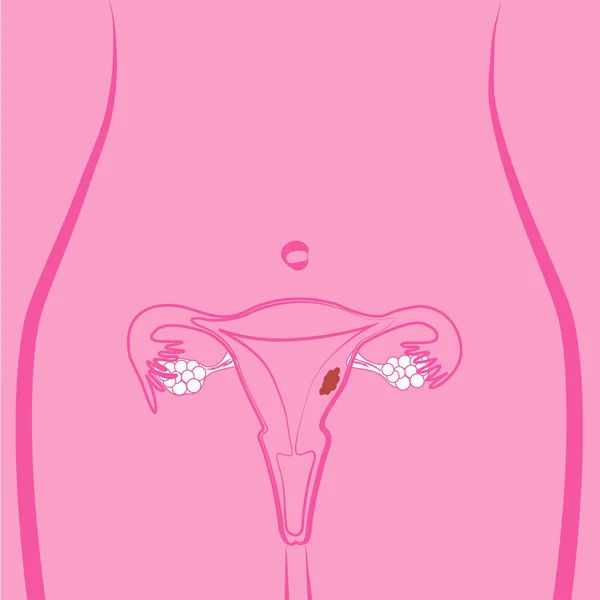 Illustrazione del vettore fibroso uterino — Vettoriale Stock