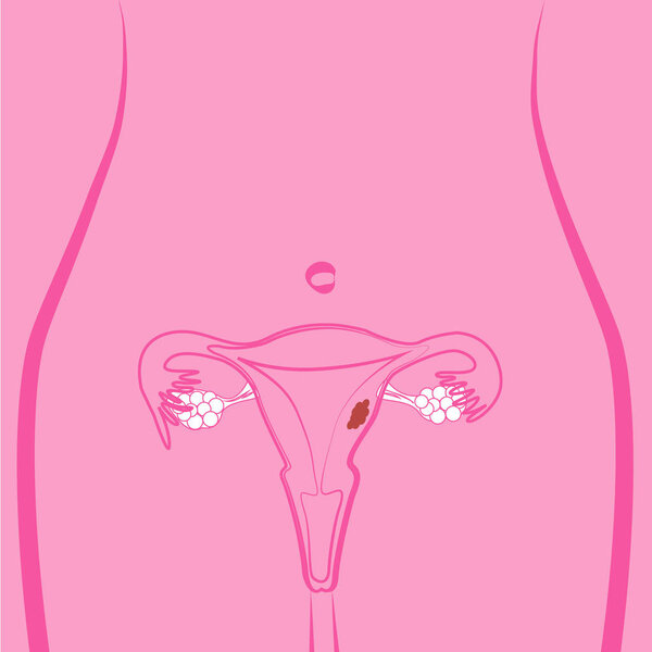Uterine Fibroid vector illustration