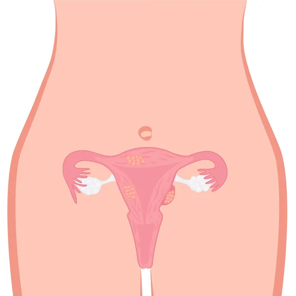 Illustrazione del vettore fibroso uterino — Vettoriale Stock