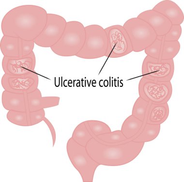Ulcerative colitis intestine disease vector graphic illustration for medical use clipart
