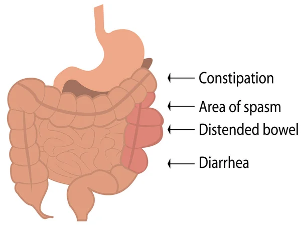 大腸のベクトル図に過敏性腸症候群 Ibs — ストックベクタ