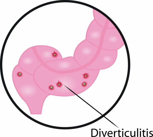 Diverticulitis Intestinalis Betegség Vektor Grafika Illusztráció Orvosi Felhasználásra — Stock Vector