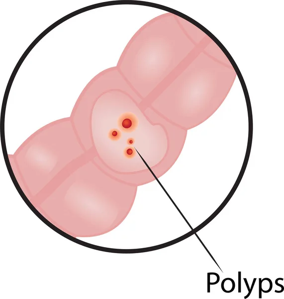 Pólipos Enfermedad Del Colon Intestinal Ilustración Gráfica Vectorial Para Uso — Vector de stock