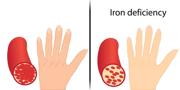 Sign Chronic Iron Deficiency Yellow Skin Vector Illustration — 스톡 벡터