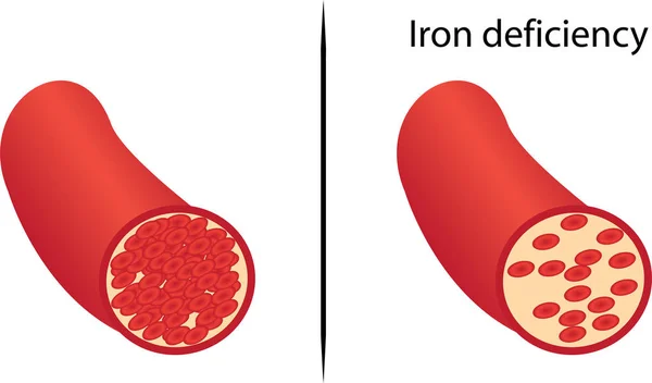 Deficiencia Crónica Hierro Amarillo Piel Vector Ilustración — Archivo Imágenes Vectoriales