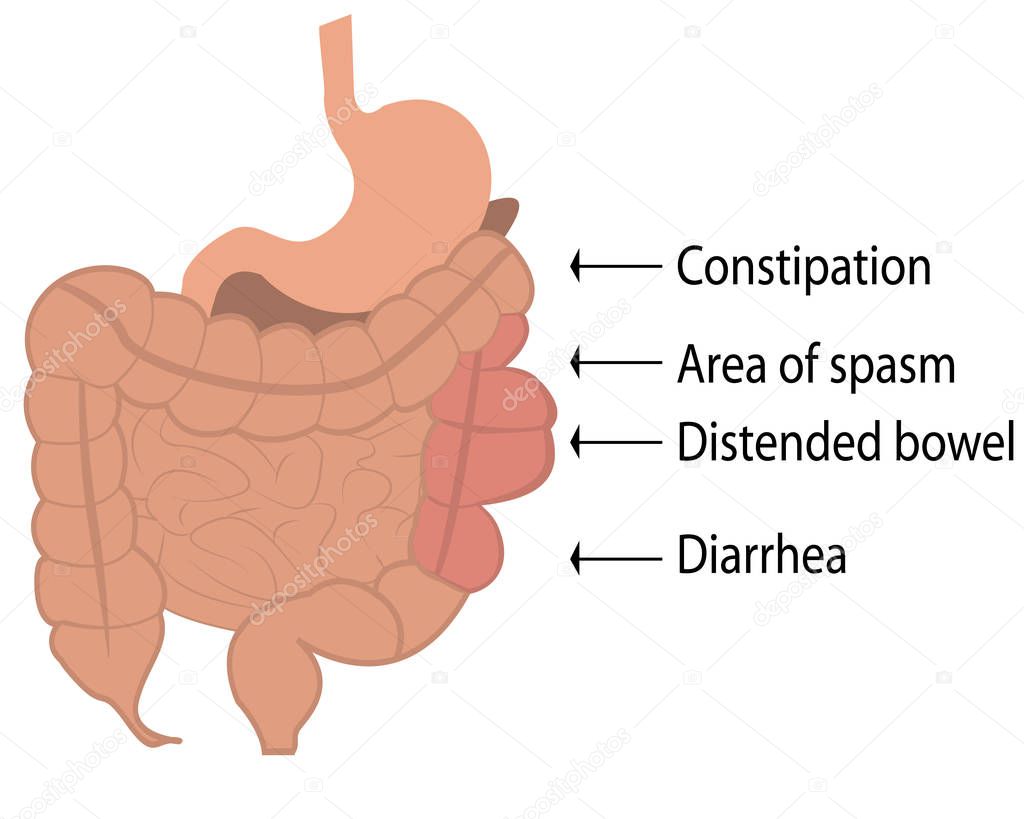 Irritable bowel syndrome (IBS) in a large intestine vector illustration