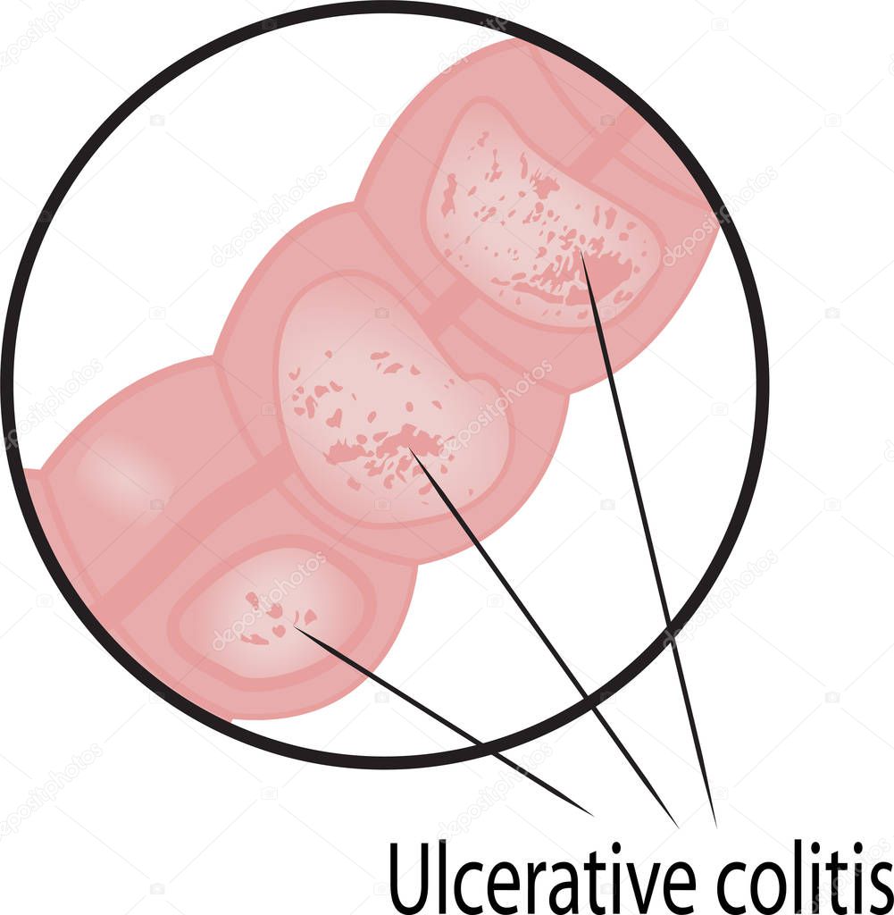 Ulcerative colitis intestine disease vector graphic illustration for medical use