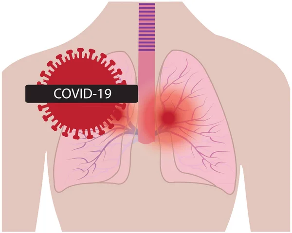 Pulmones afectados por infección por coronavirus COVID19 — Vector de stock