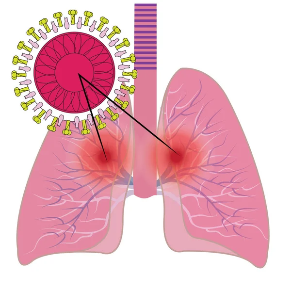 Pulmones afectados por infección por coronavirus COVID19 — Archivo Imágenes Vectoriales