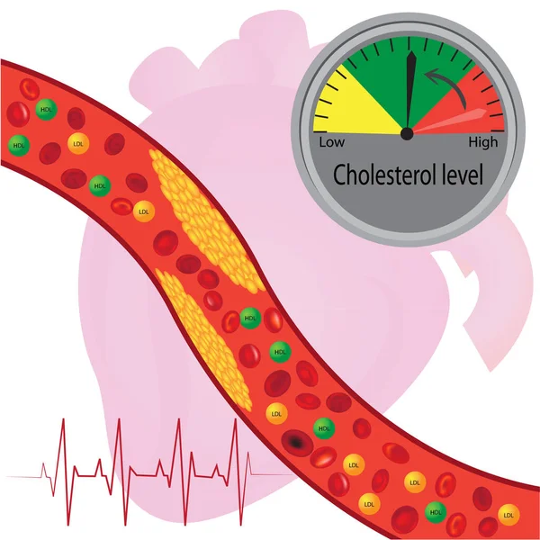 血管内のアテローム性動脈硬化症のプラーク 血液ベクトル図で良いと悪い脂質それらの調節 — ストックベクタ