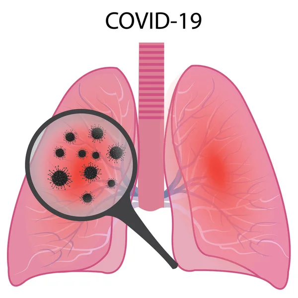 Plíce Postižené Infekcí Koronavirem Covid19 Vektorové Ilustrace Izolované Bílém Pozadí — Stockový vektor