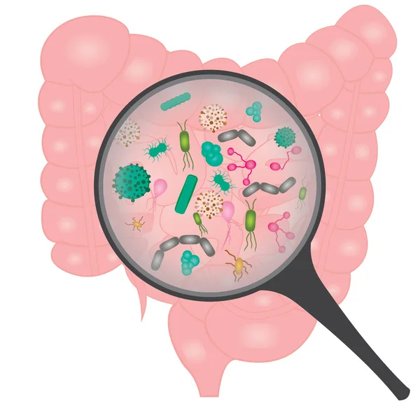 小腸での細菌の過剰増殖 虫眼鏡ベクトル図の下の細菌 — ストックベクタ
