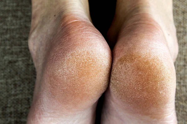 Yatakta kadın ayakları kırık Cilt Kuru. Ayak tedavisi.