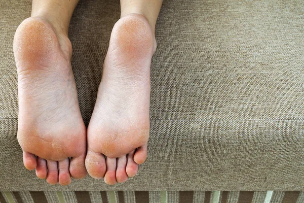 침대에서 여자 피트의 금이 피부 건조. 발 치료. — 스톡 사진