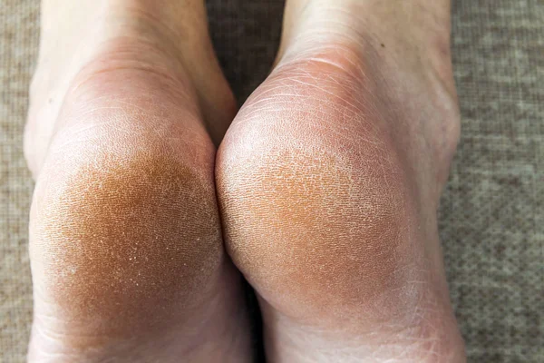 Piel seca agrietada de pies de mujer en la cama. Tratamiento de los pies . —  Fotos de Stock