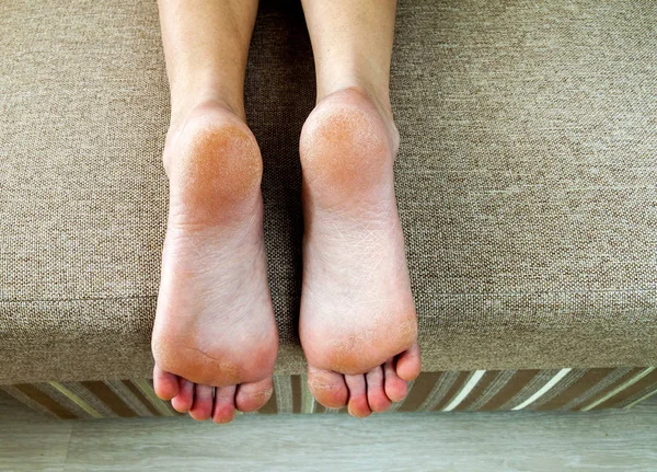 Trockene rissige Haut der Frauenfüße im Bett. Fußbehandlung. — Stockfoto