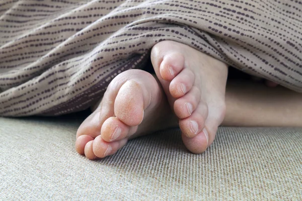 Torr sprucken hud kvinna fötter i sängen. Fotbehandling. — Stockfoto
