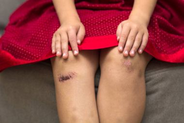 Küçük kız yaralı yaralı hasarlı dizi tutan Close-Up
