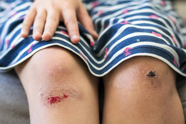 Κοντινό πλάνο του κοριτσάκι που κρατάει το μελανιασμένο τραυματισμένο γόνατο είναι κατεστραμμένο — Φωτογραφία Αρχείου