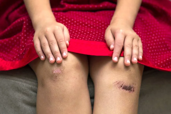 Primer plano de la niña sosteniendo su rodilla dañada herida con moretones —  Fotos de Stock