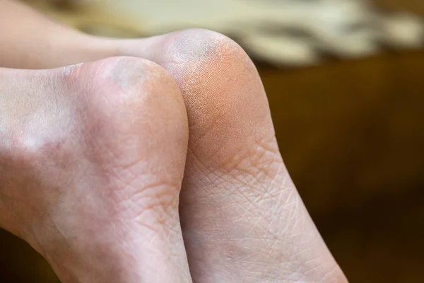 Closeup of woman feet sole with dry cracked skin. Foot and toes
