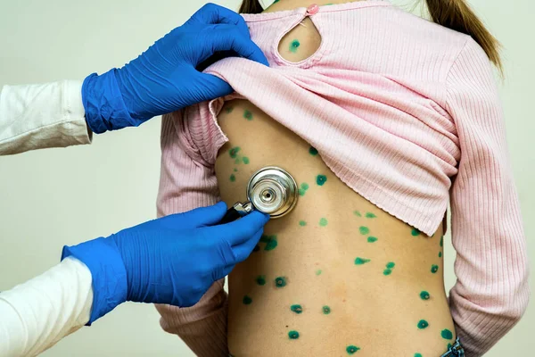 Doctor examining a child with stethoscope covered with green rashes on back ill with chickenpox, measles or rubella virus.