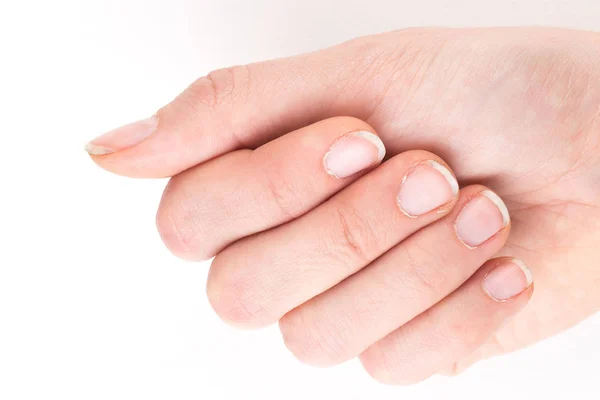 Ręka z manicure brzydkie — Zdjęcie stockowe